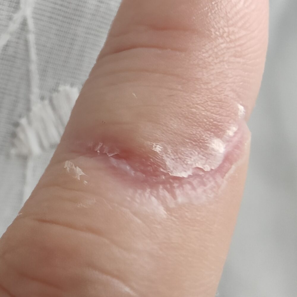 包丁で切って約3週間後の左手人差し指の傷跡