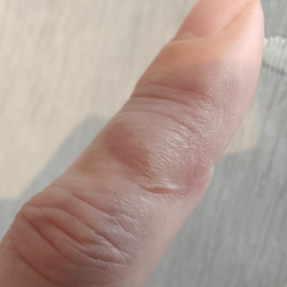 包丁で切って約8週間（2か月）後の左手人差し指の傷跡