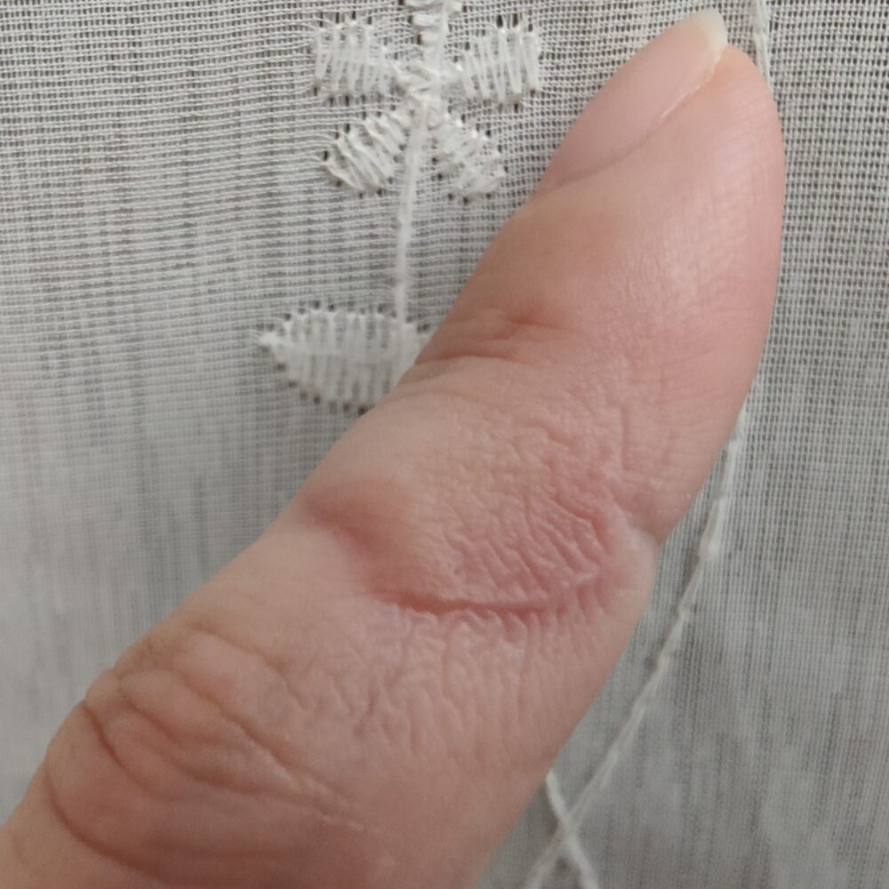 包丁で切って約5週間後の左手人差し指の傷跡