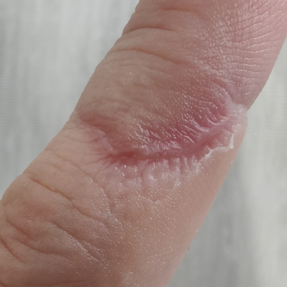 包丁で切って約4週間（1か月）後の左手人差し指の傷跡